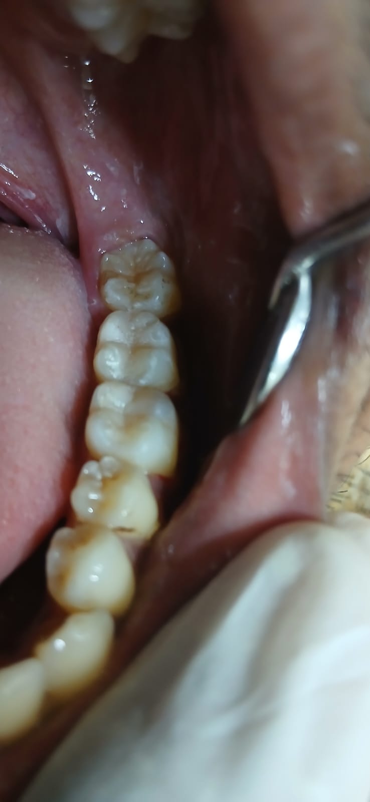 সামনের দাঁতের ক্ষয় মেরামত - পরে