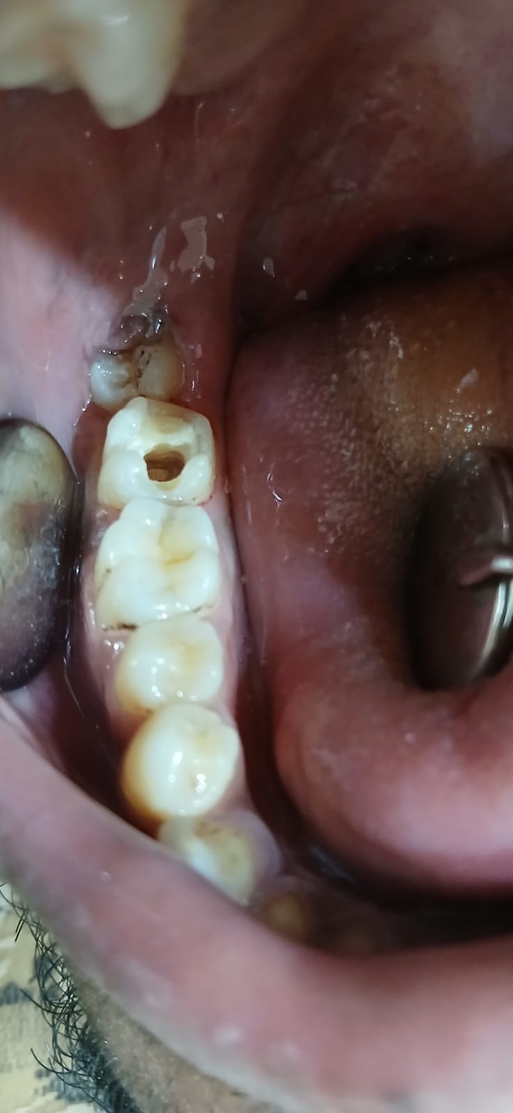 সামনের দাঁতের ক্ষয় মেরামত - আগে