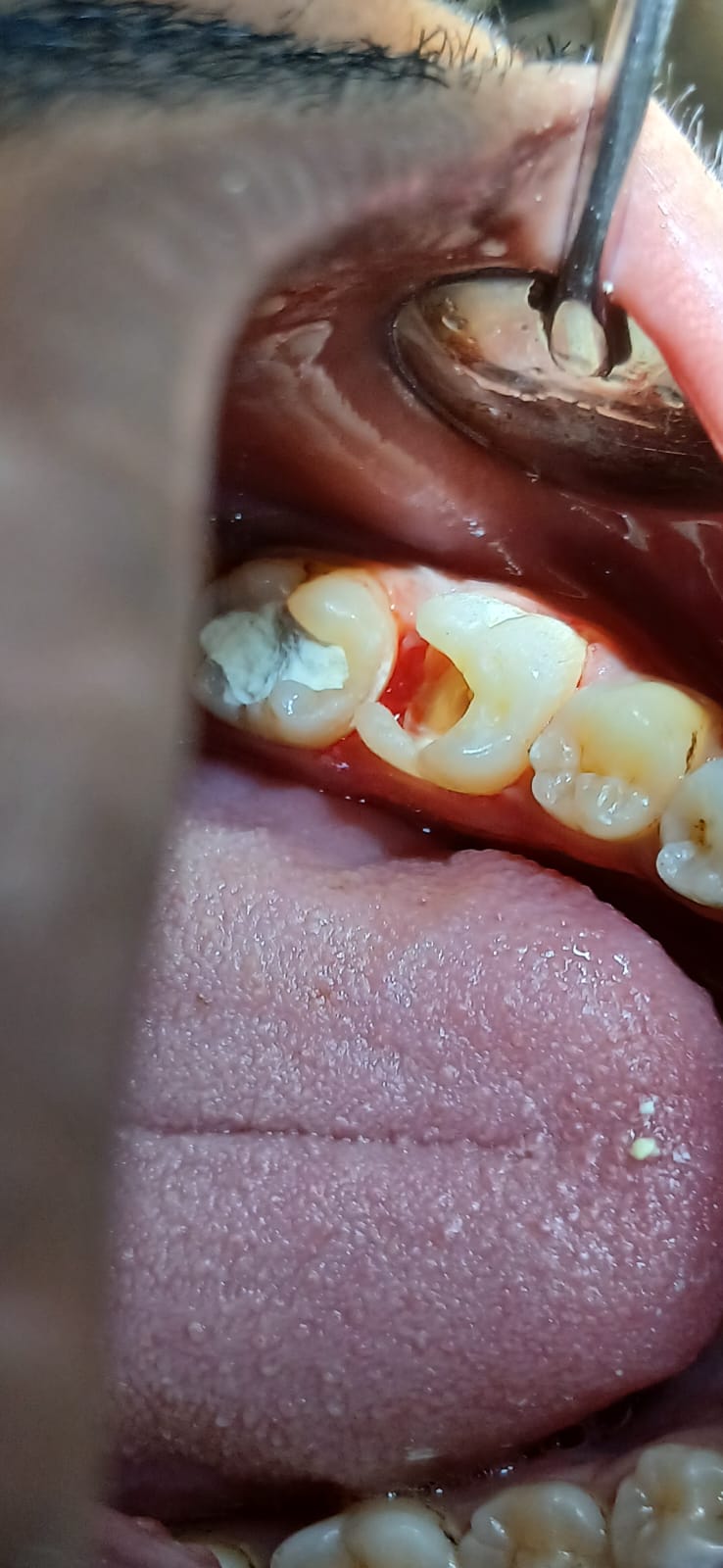 ভাঙা দাঁত পুনর্গঠন - আগে