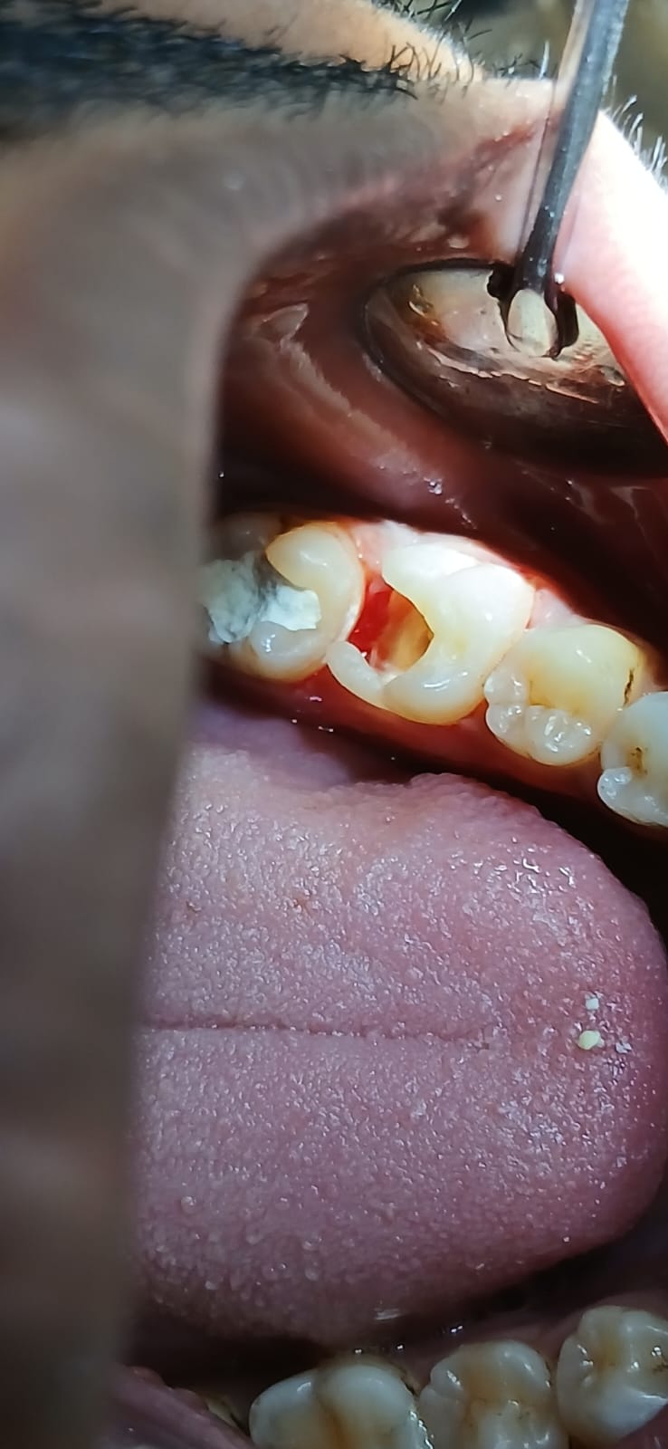 দাঁতের ফাঁক বন্ধ - আগে